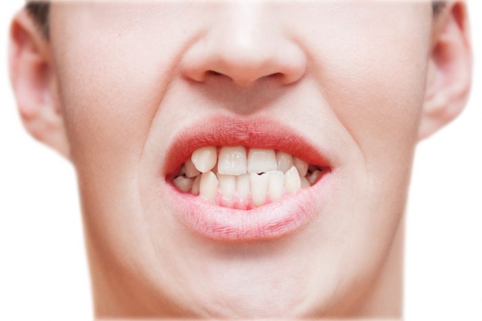 What Causes Crooked Teeth| What to Know About Underbite