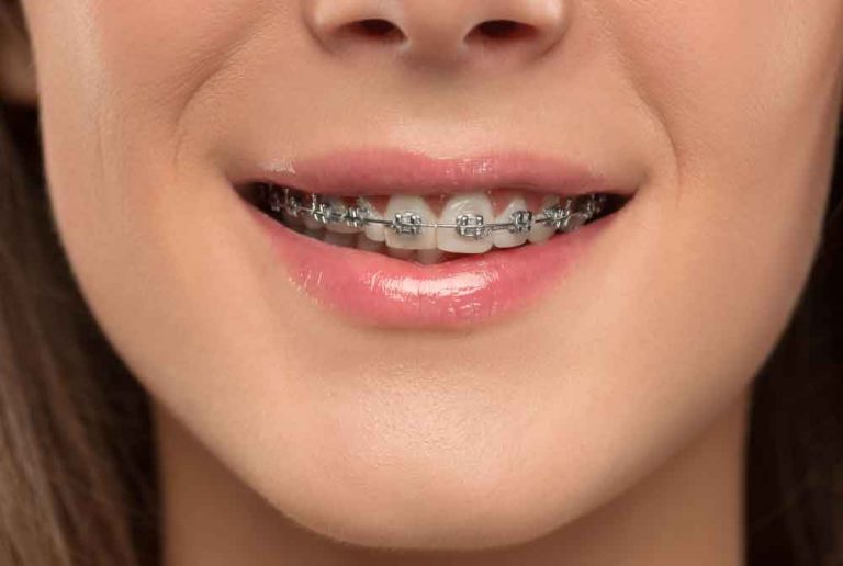 How To Pick The Best Orthodontist in Aventura, for Yourself & Your Child?| What Is an Orthod ...