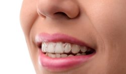 Find an Invisalign Doctor at Invisalign Locations |What Is an Orthodontist?
