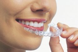 How can Invisalign Invisible Aligners be used to fix Overbites or Underbites| What to Know About ...