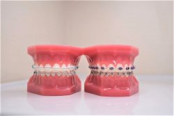 How You Can Find Your Best Orthodontist Aventura Fl | What to Know About Underbite