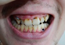How Long Until a Tooth Infection Kills You | Urban Dental Centre