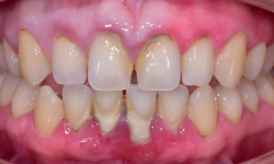 Deep Dental Cleaning for Gum Disease Treatment | Urban Dental Centre