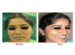 Best Nose surgery price in India | Dr. Vivek Kumar