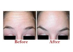 Best Botox Treatment in Guwahati | Sculpt India