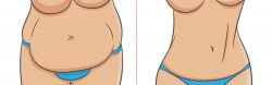 What are the After-Effects of a Tummy Tuck? | Dr Rajat Gupta