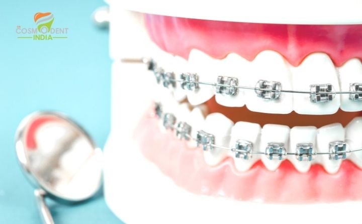 CosmodentIndia For Lowest Teeth Brace Cost India