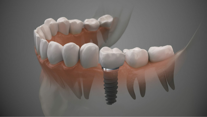 Best Dental Implants In Illawarra