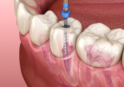 Permenant Dental Implants In Wollongong