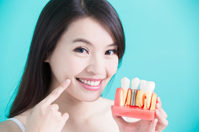 Things You Need To Know Before Getting Dental Implants