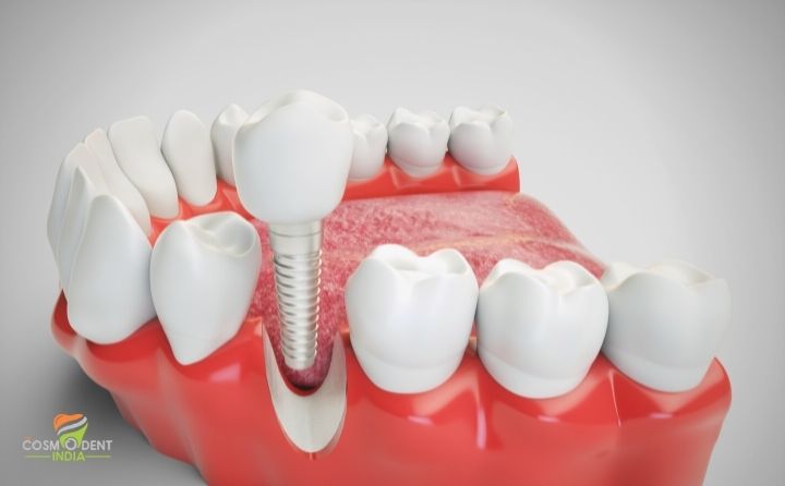 Comsodent India Best For Dental Implants
