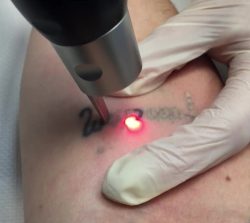 Tattoo Removal Service