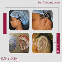 Ear Surgery in USA, England, India
