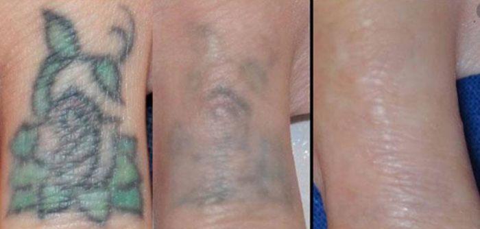 Laser Tattoo removal