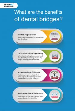 How Much Does The Dental Bridge Cost?