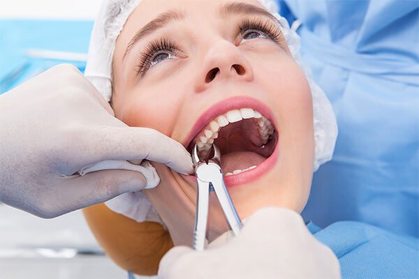 Importance of Tooth Extraction | Tooth Whitening