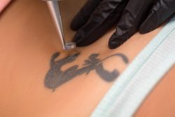 Best Laser Tattoo Removal NY | Skin Clinic Tattoo Removal NY – Bared Monkey