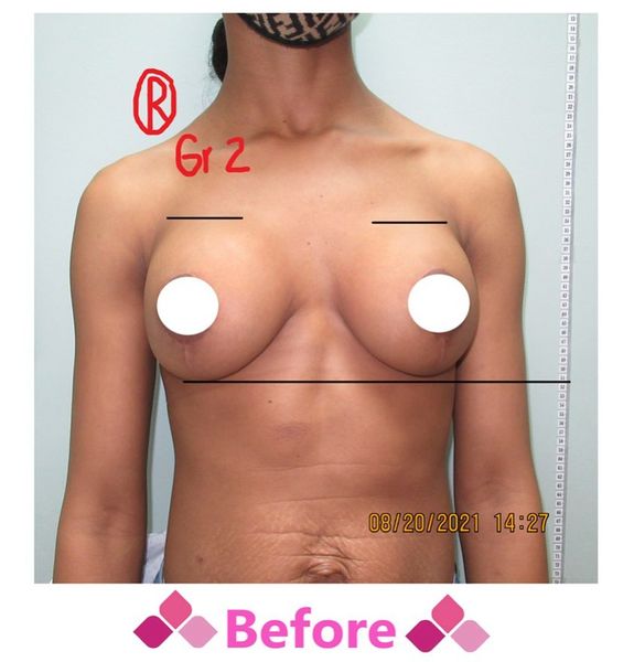 breast implant hard