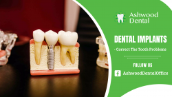 Best Dental Restoration With Implants