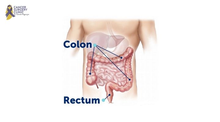 Cancer Surgeons Doctor For Colorectal in Mumbai