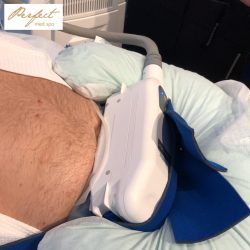 Coolsculpting In New York city