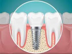 Restoring your Smile with Emergency Tooth Replacement
