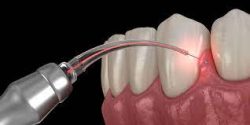 Laser Dentistry – Advanced Laser Dentistry Treatments For Cavities