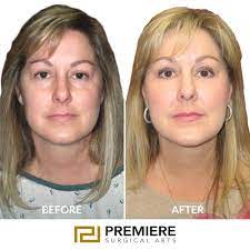 Facelifts Houston, TX | Cosmetic Surgery | Premiere Surgical Arts