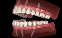 Affordable Dental Implants Near Me | Dental Implant Surgery in Houston