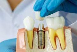 Dental Implants Near Me | Dental Implant Procedure | Implant Dental surgeon