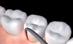 LANAP Periodontist Near Me | LANAP Treatment Houston TX – Edge Dental