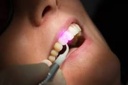 Laser Dental Clinic Houston TX | Laser Dental Surgery Near Me