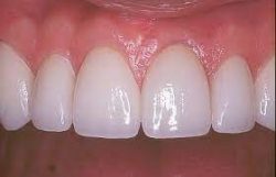 Types of Dental Fillings | Porcelain Composite Fillings | Amalgam fillings