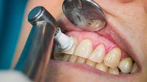 Dental Crown Near Me | Types of Dental Crown Procedure