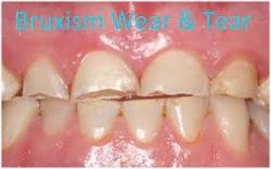 Severe Bruxism Treatment | Bruxism (Teeth Grinding Treatment)