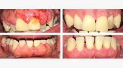 Gum Regeneration Treatment | Gum Recession Treatment Surgery