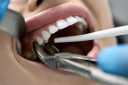 Important Things You Should Know Before Getting Tooth Extraction | Dental Sealants