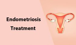 Endometriosis Doctor in Jaipur