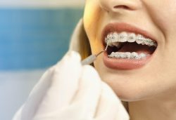 What is Pre-existing Ridge Augmentation? |Teeth Whitening