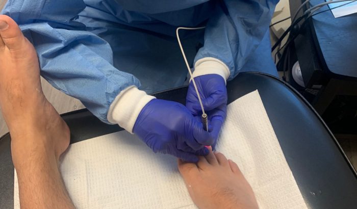 Get rid of icky Fungal Nails with a Laser Treatment from Anderson Podiatry