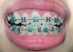 Braces Before And After Overbite | Metal Braces