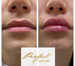 Lip Laser Treatment For Plumping