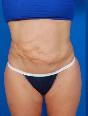 Liposuction Lumpy and Bumpy treatment Orlando Florida