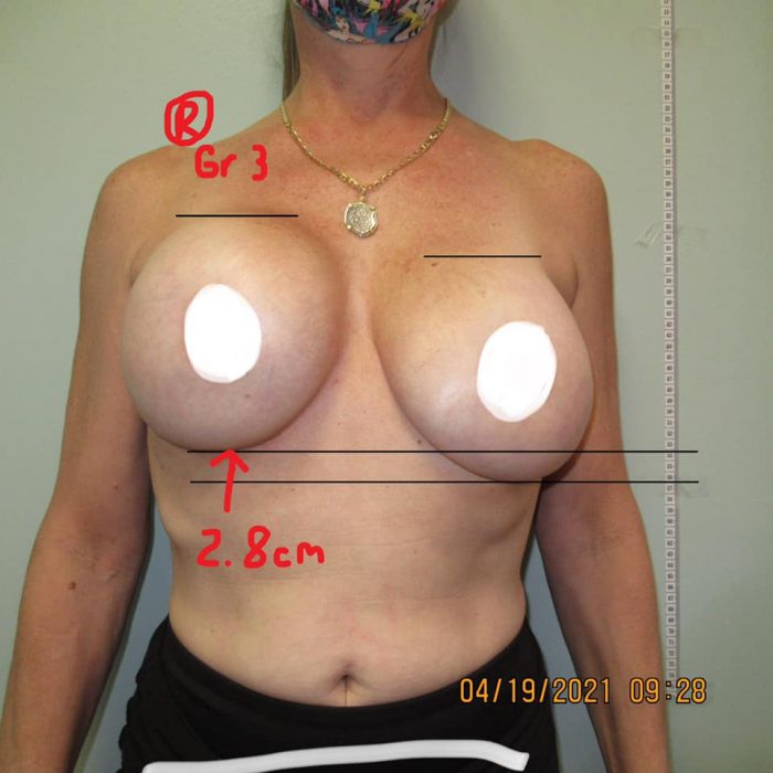 Breast Implant Complications
