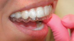 Bad Breath and Retainers | Orthodontic Experts