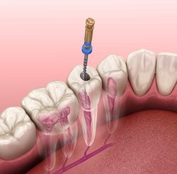 What is Root Canal Therapy? Dental Clinic Upper Kirby