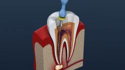 Root Canal Treatment | Teeth Whitening