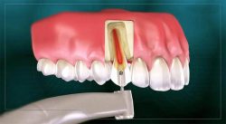 Can Front Teeth Have a Root Canal?
