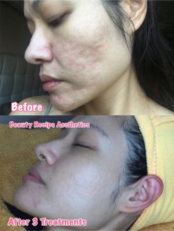 Top Acne Scar Treatment In Singapore