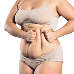 Famous Tummy Tuck Surgery In Cape Town